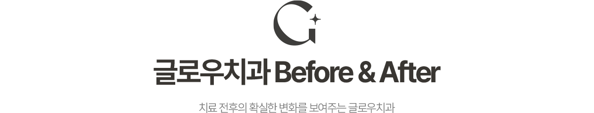 글로우치과 Before & After 치료 전후의 확실한 변화를 보여주는 글로우치과