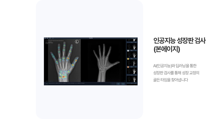 인공지능 성장판 검사 (본에이지)
