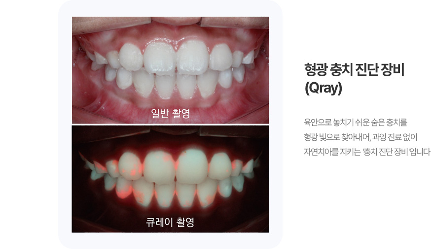 형광 충치 진단장비 (Qray)