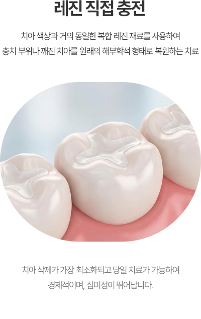 레진 직접 충전 활성화