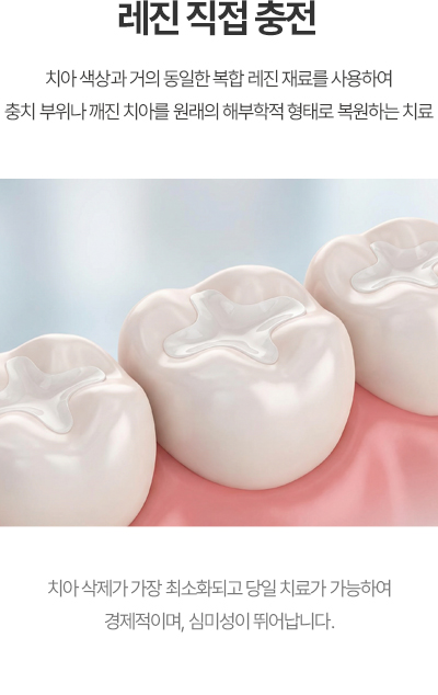 레진 직접 충전