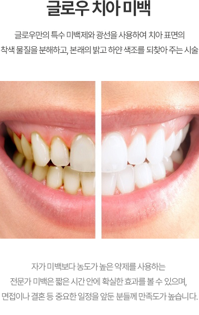 글로우 치아 미백