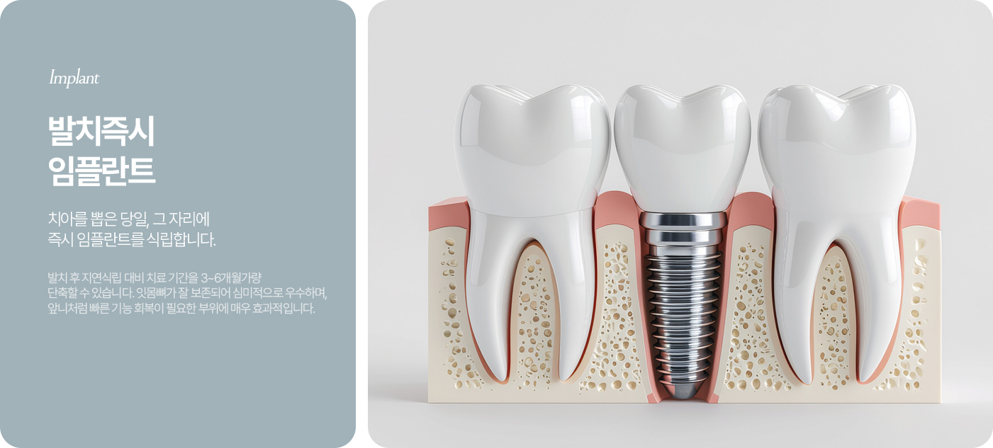 뼈이식 임플란트
