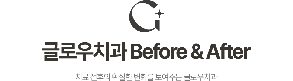글로우치과 Before & After 치료 전후의 확실한 변화를 보여주는 글로우치과