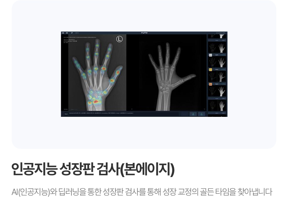인공지능 성장판 검사 (본에이지)
