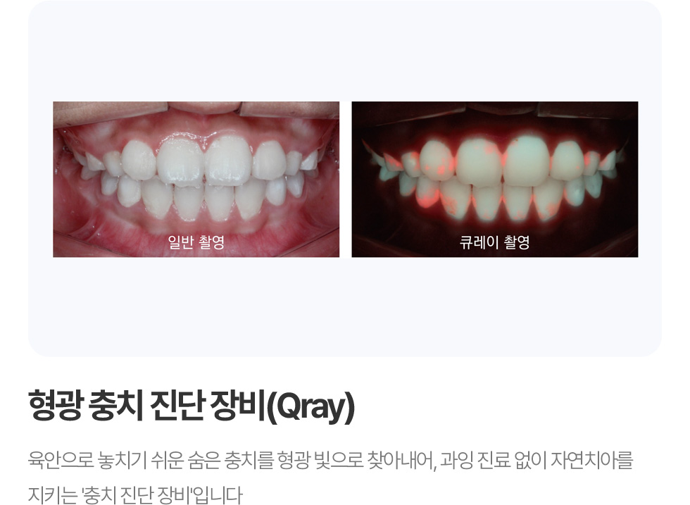 형광 충치 진단장비 (Qray)
