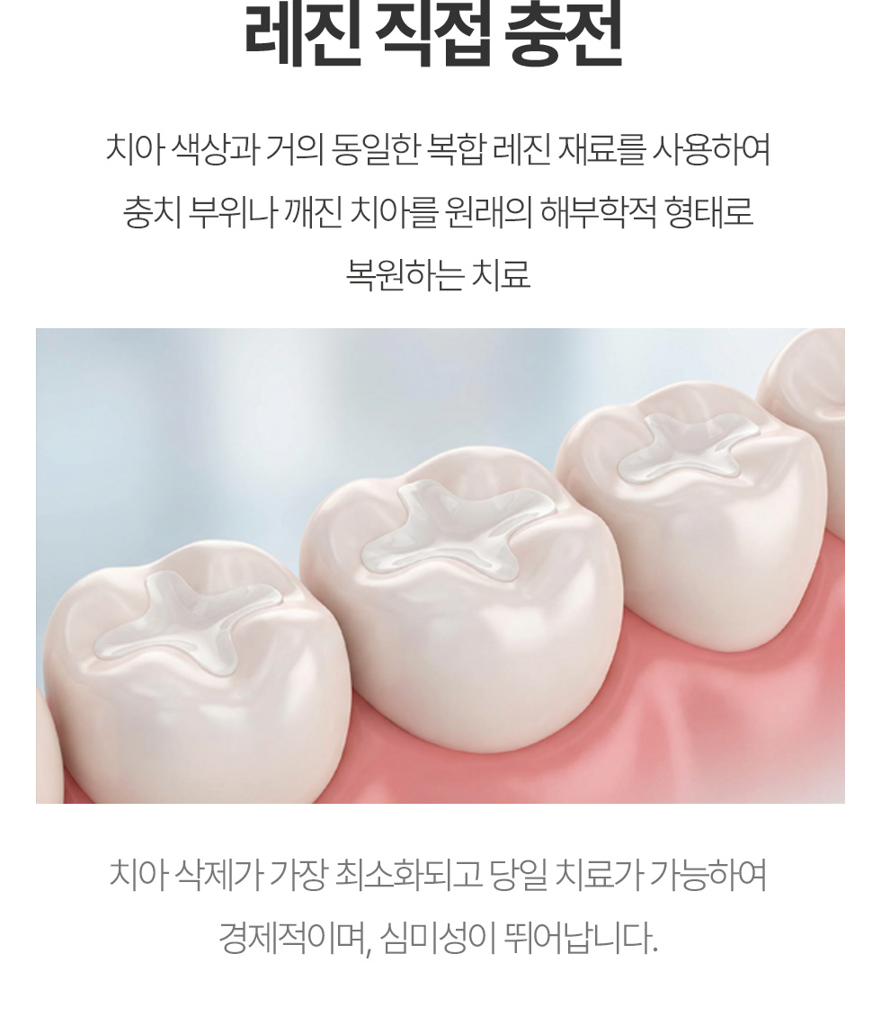 레진 직접 충전