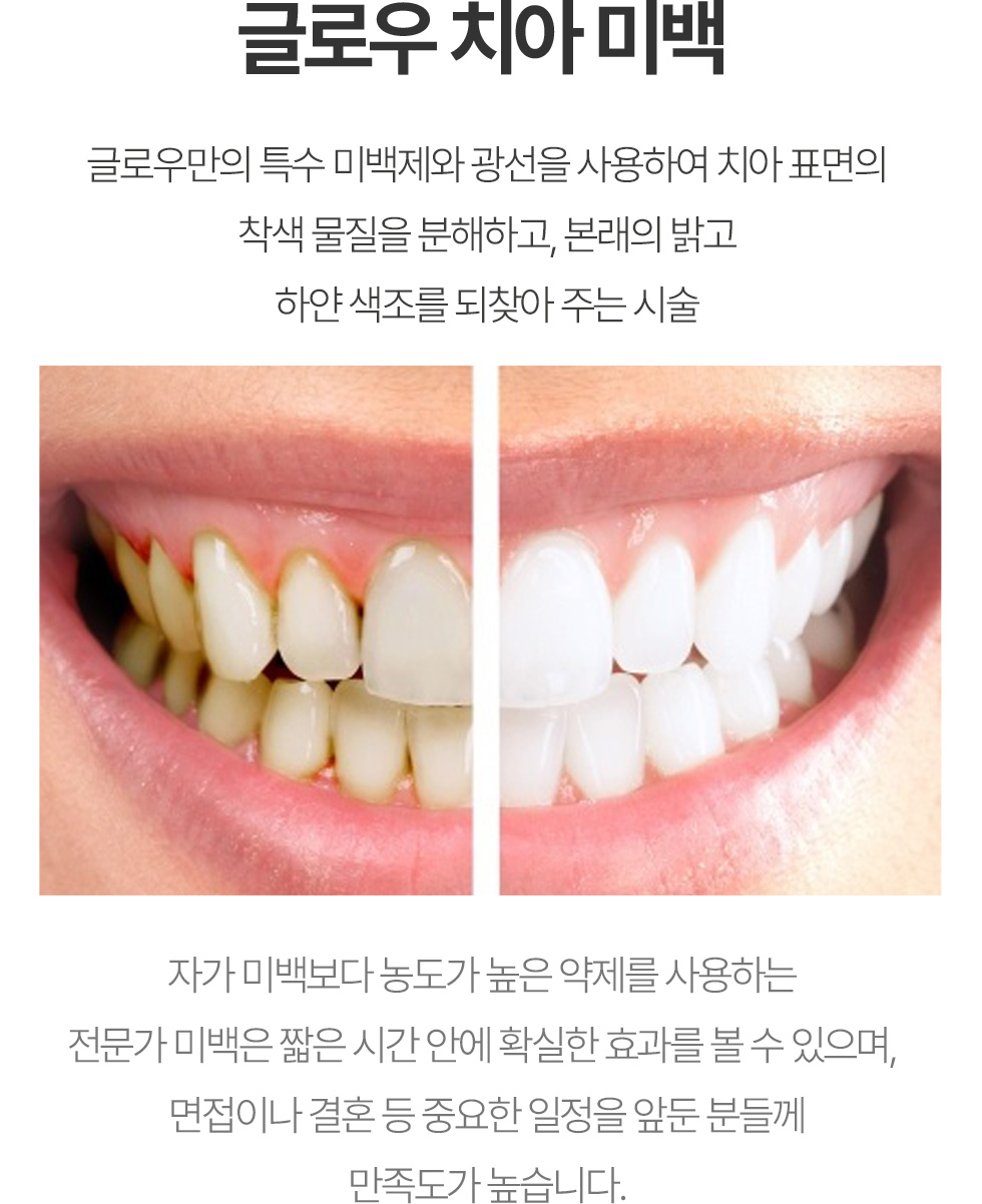 글로우 치아 미백