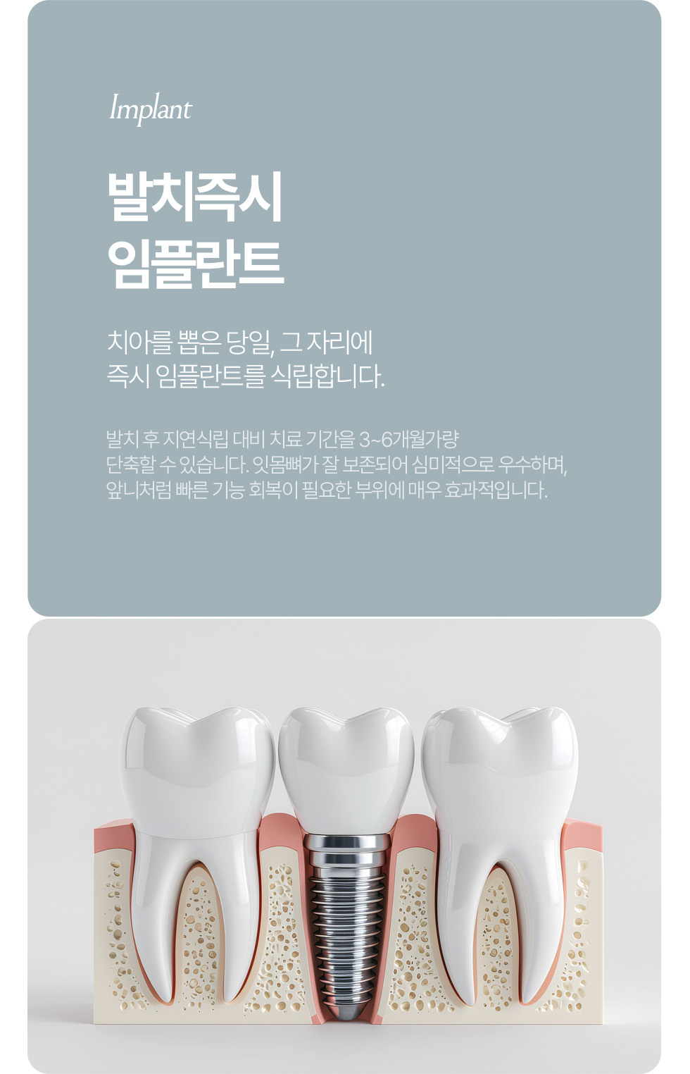 뼈이식 임플란트