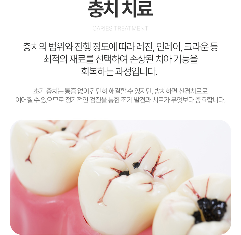 충치치료