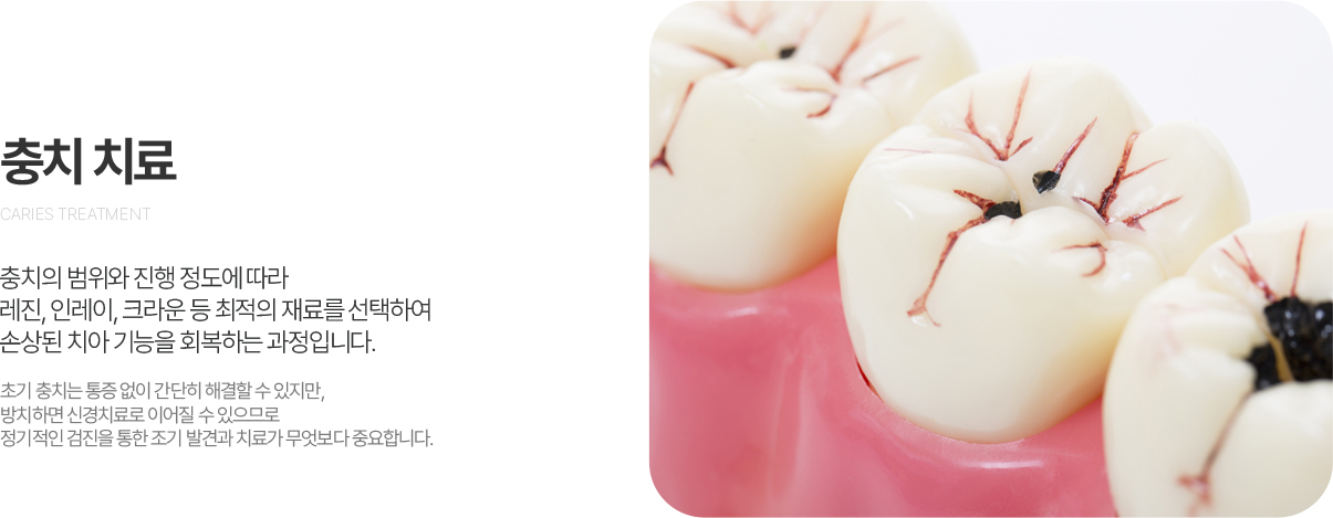 충치치료