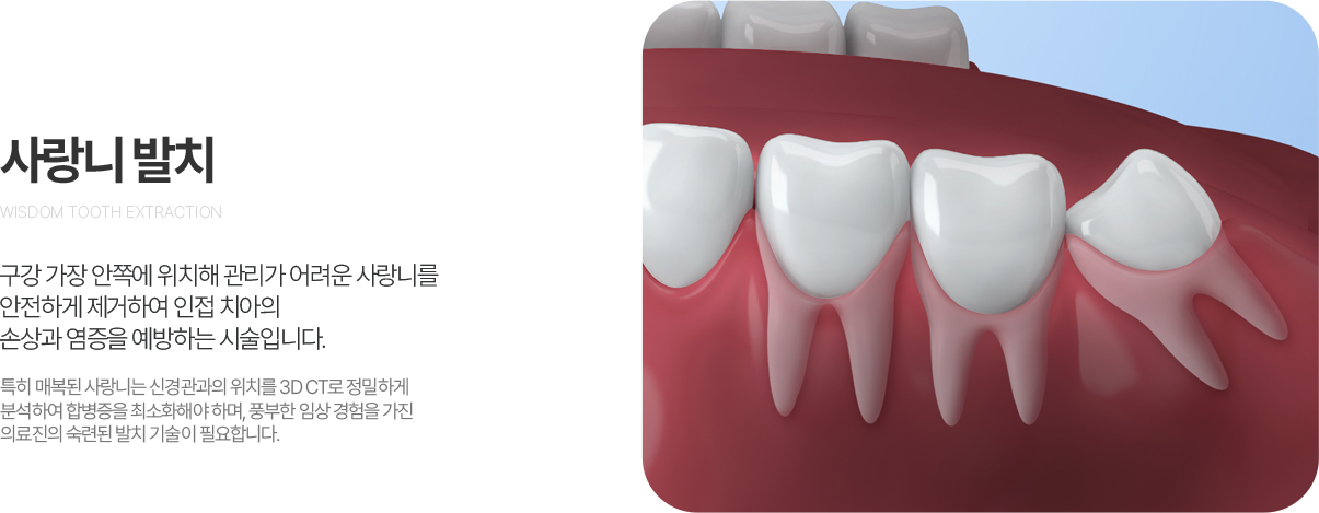 사랑니발치